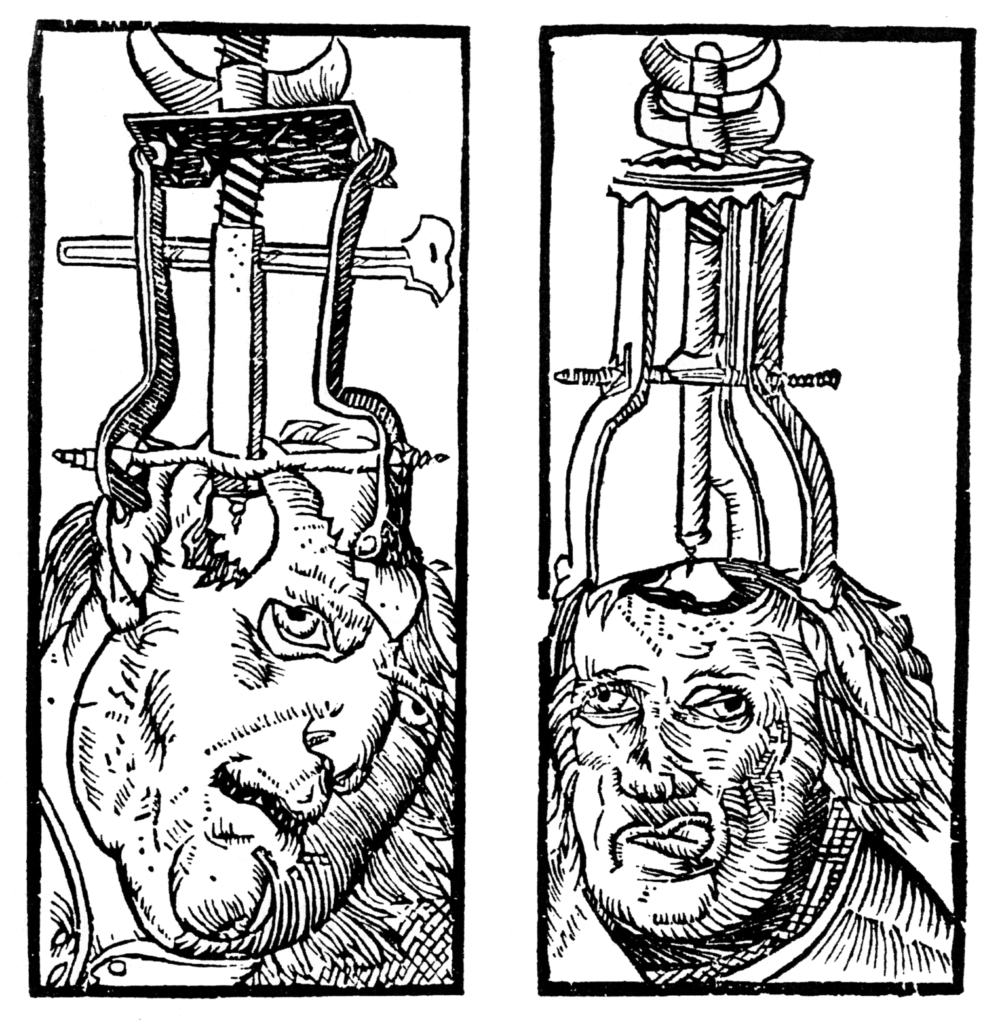 el trepanado como medicina medieval habitual